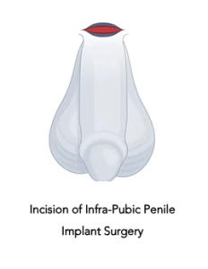 Infrapubic